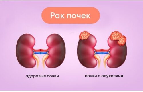 4 Что такое рак почки?