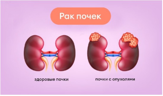 Что такое рак почки?
