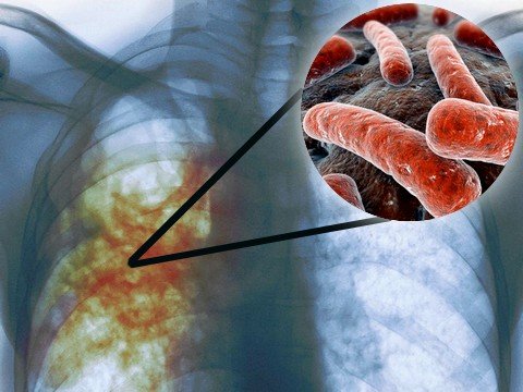 Туберкулез актуален и в наше время