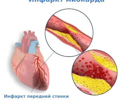 Инфаркт миокарда