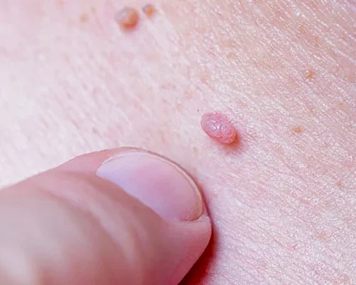 Вопросы и ответы о вакцинации против инфекции, вызванной вирусом папиломы человека (ВПЧ-инфекции)