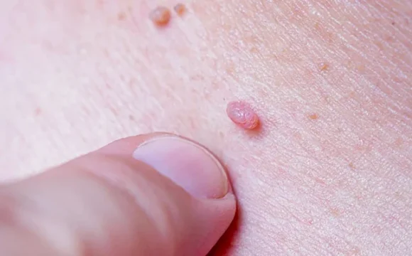 Вопросы и ответы о вакцинации против инфекции, вызванной вирусом папиломы человека (ВПЧ-инфекции)