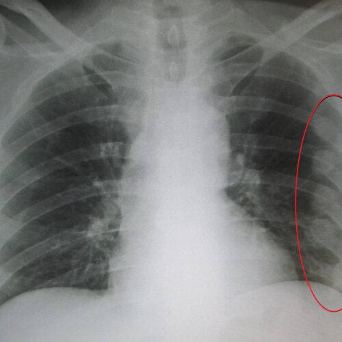 Fracturedribsmarked Сломано ребро. Что делать?