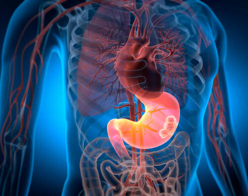 Medical Illustration of Male Anatomy with Stomach Cancer - 3D Illustration Рак желудка