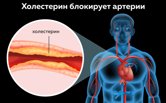 ТОП-7 продуктов снижающих уровень холестерина