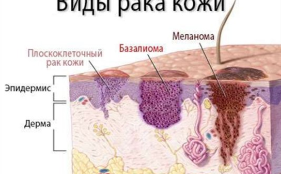 Что нужно знать о раке кожи