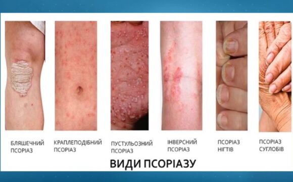100000 Как научиться контролировать псориаз